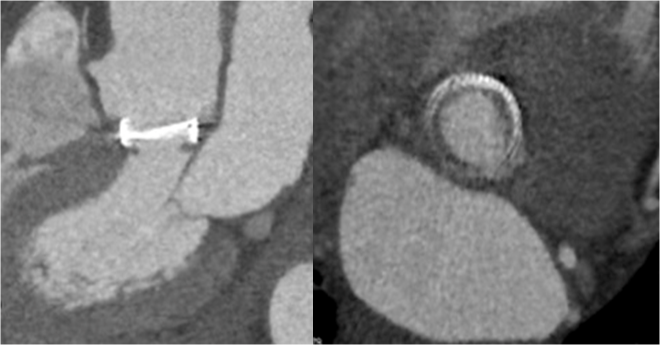 Cas clinique : Scanner sur la prothèse mécanique aortique