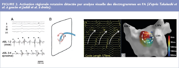 Activation régionale rotatoire détectée par analyse visuelle des électrogrammes en FA