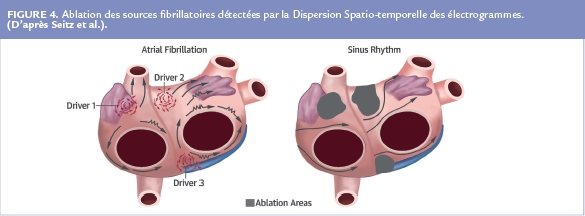 Ablation des sources fibrillatoires détectées par la Dispersion Spatio-temporelle des électrogrammes.