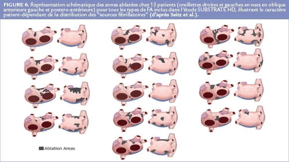 Représentation schématique des zones ablatées chez 13 patients